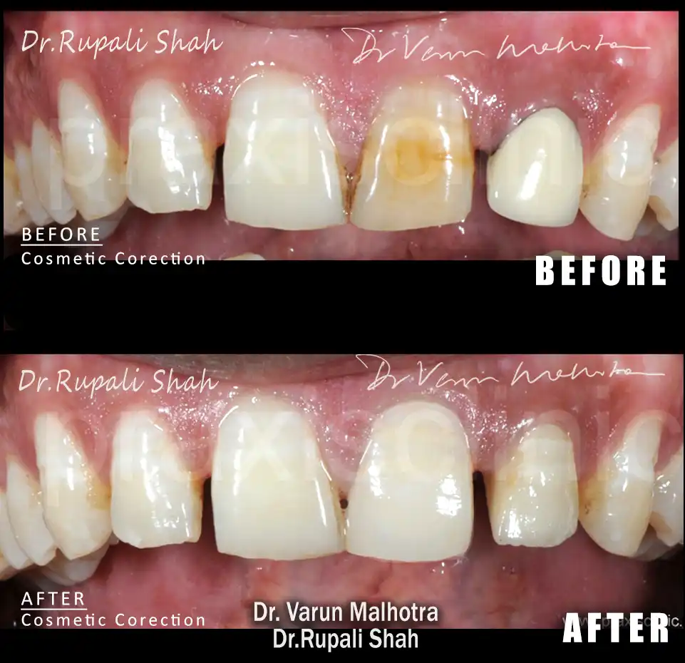porcelain veneers cosmetic dentistry Mumbai India